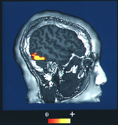 Computer-enhanced fMRI scan with activity highlighted near the fusiform face area.